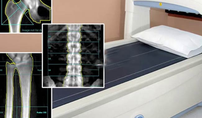 Giornata mondiale osteoporosi, quali sono i messaggi fuorvianti